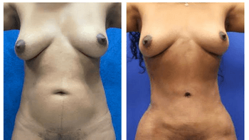 before and after